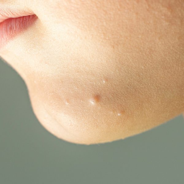 Close-up of Molluscum Contagiosum also called water wart. Viral formations in the chin on the skin of the child | Kay Dermatology in Burbank, CA