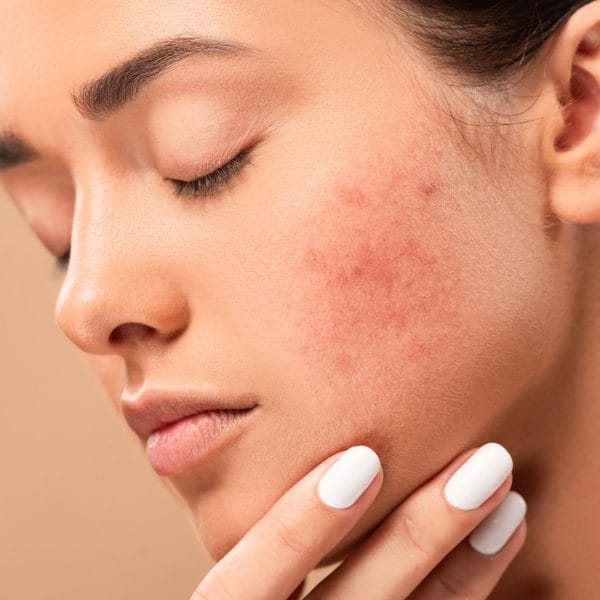 Rosacea Treatment | Kay Dermatology in Burbank, CA