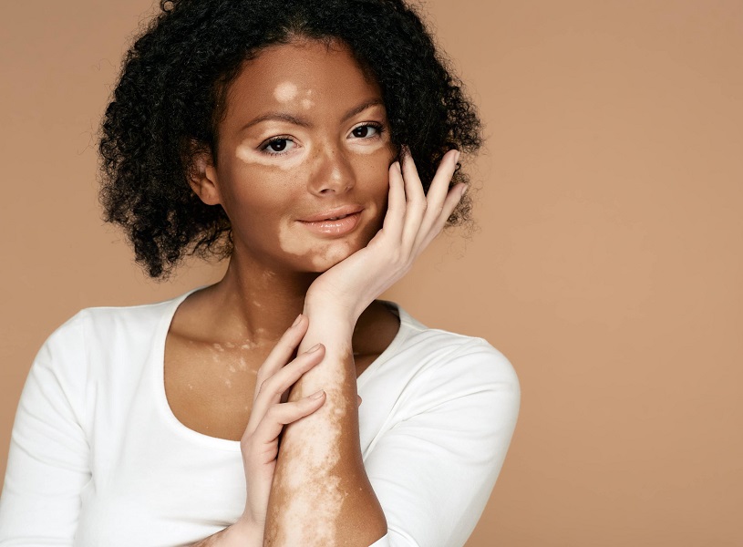 Young woman demonstrates her skin spots on her hands and face with vitiligo | Kay Dermatology in Burbank, CA