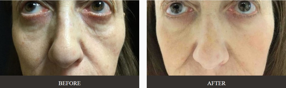 Chemical Peel Before and After Image | Kay Dermatology in Burbank, CA