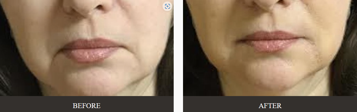 Injectable Fillers Before and After Image | Kay Dermatology in Burbank, CA