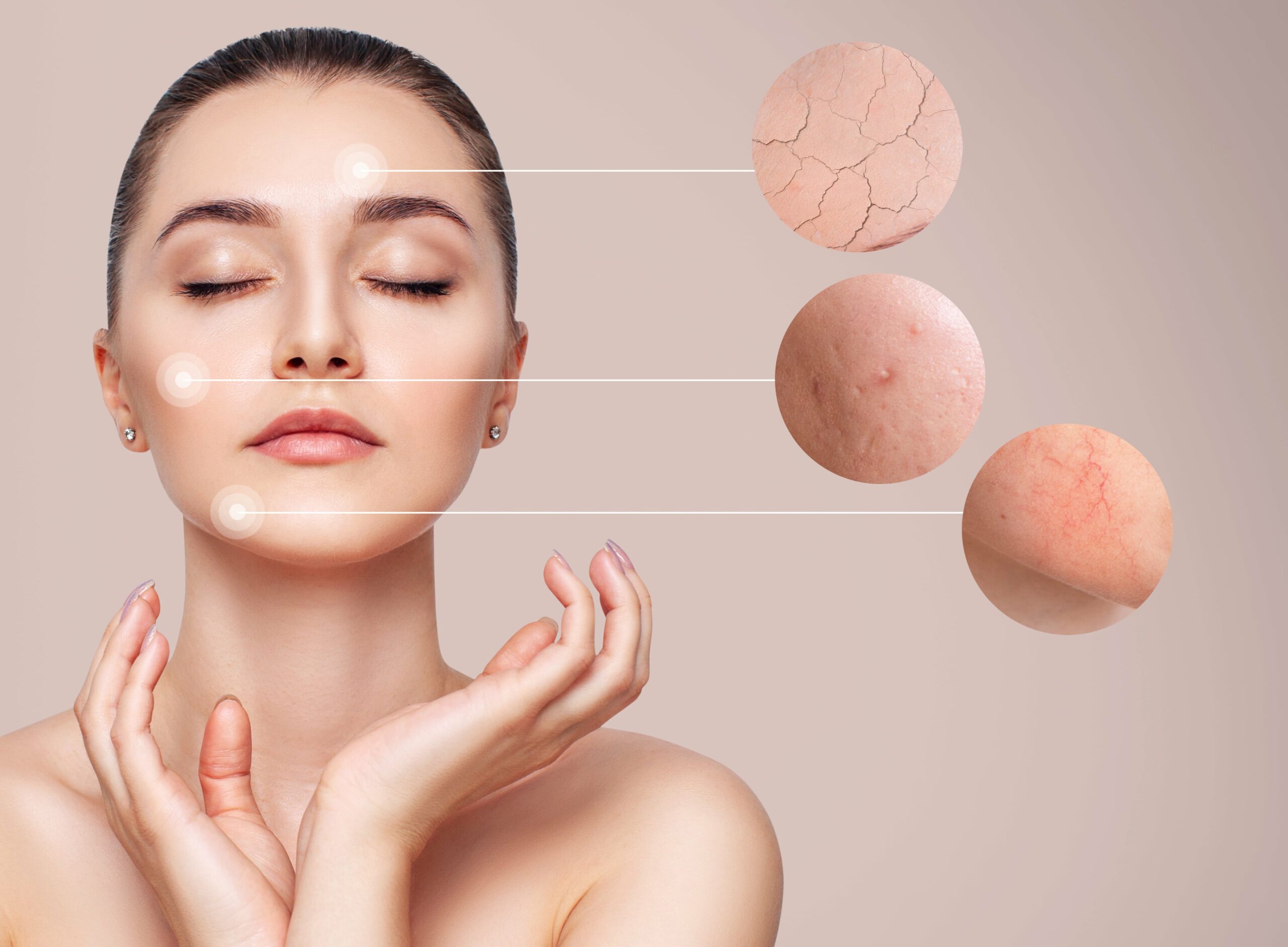 Acne Treatments by Kay Dermatology in Burbank CA