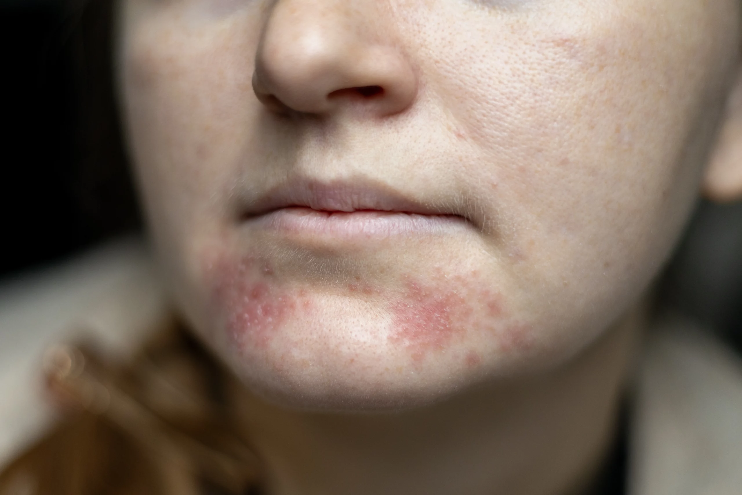 Rosacea by Kay Dermatology in Burbank CA