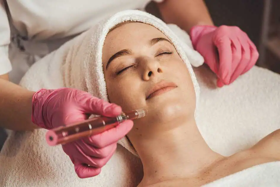 Microneedling Treatment in Burbank, CA by Kay Dermatology