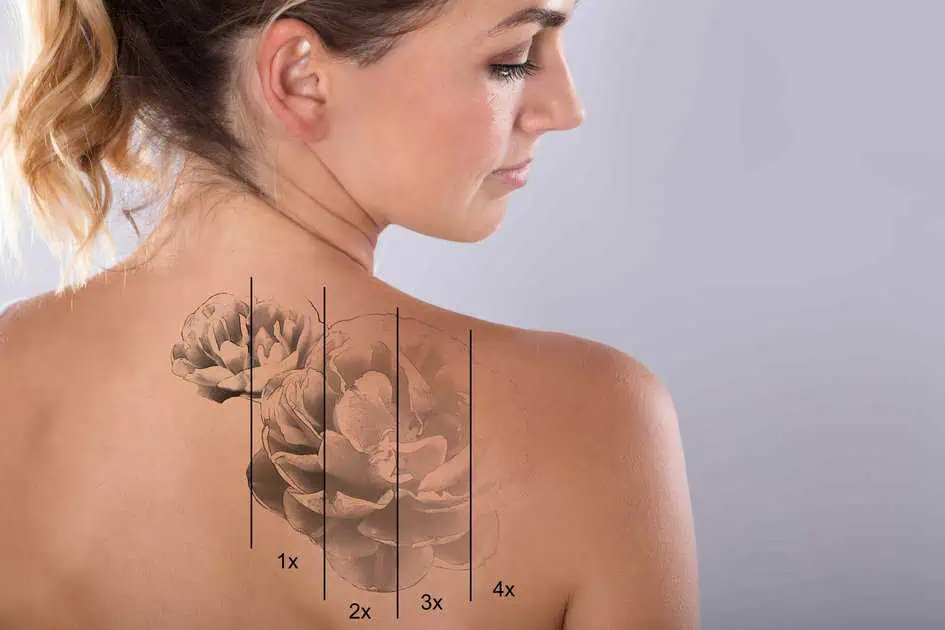 Laser Tattoo Removal in Burbank, CA by Kay Dermatology