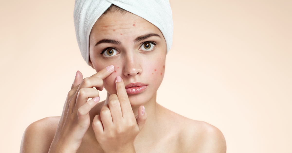 Young Woman with Facial acne treatment focusing on blemished cheeks in Burbank, CA