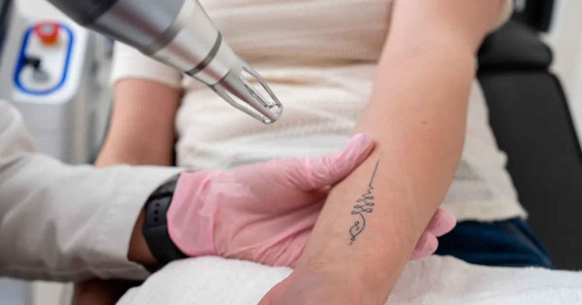 Laser tattoo removal treatment being performed on a forearm in Burbank, CA