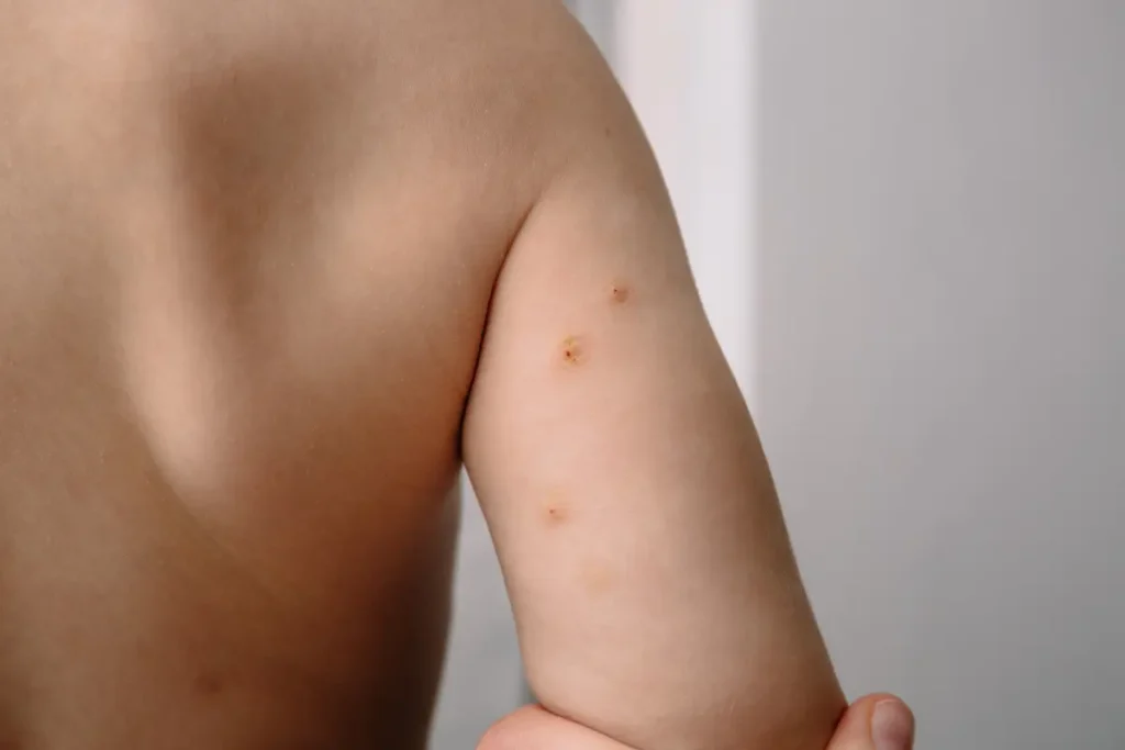 How Molluscum Spreads and Why It's So Common 1 Close-up of Molluscum contagiosum bumps on a child’s arm in Burbank, CA
