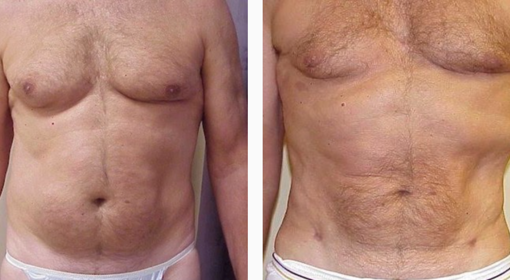 Male Before & After Liposuction Treatment Photo | Kay Dermatology in Burbank, CA
