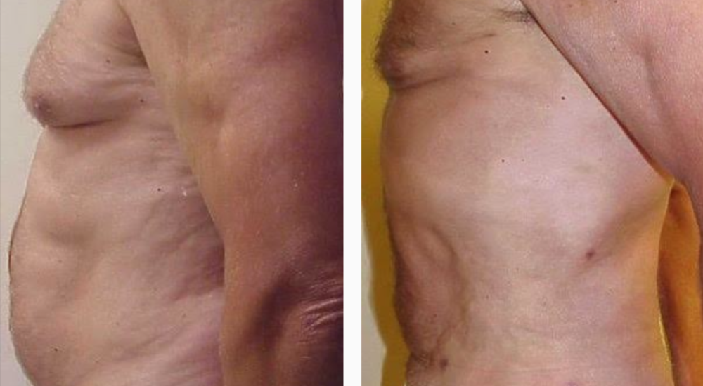 Male Before & After Liposuction Treatment Photo | Kay Dermatology in Burbank, CA