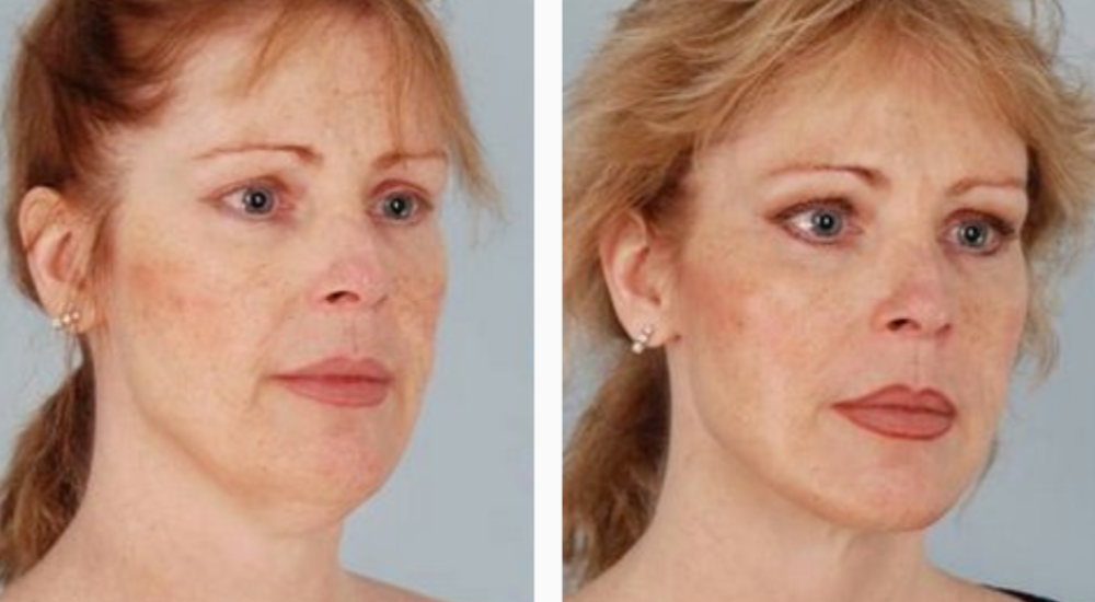 Female Before & After Liposuction Treatment Photo | Kay Dermatology in Burbank, CA