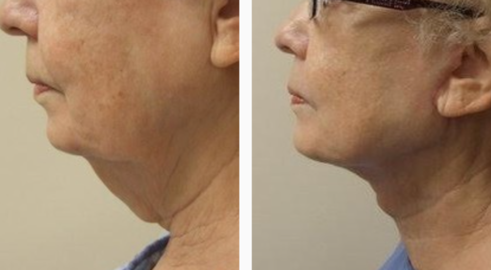 Before & After Neck lift Treatment results | Kay Dermatology in Burbank, CA