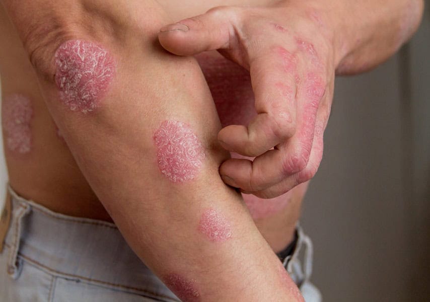 The man on the arm and abdomen spots psoriasis | Kay Dermatology in Burbank, CA
